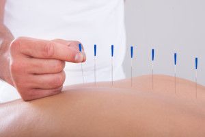 acupuncture back pain