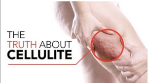 Cellulite